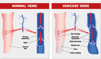 Varicose Vein Surgery and Treatment